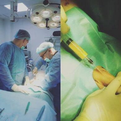 O engrosamento do pene é posible coa axuda da cirurxía