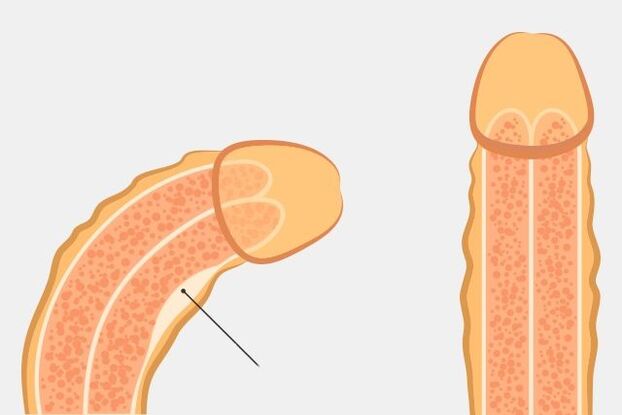 forma eficaz de endereitar o pene