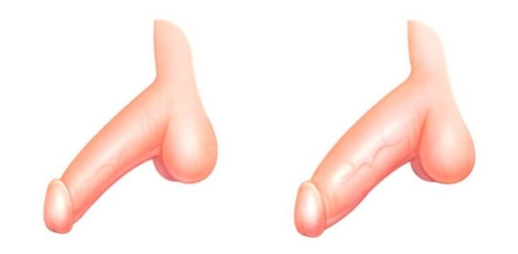 pene antes e despois da ampliación